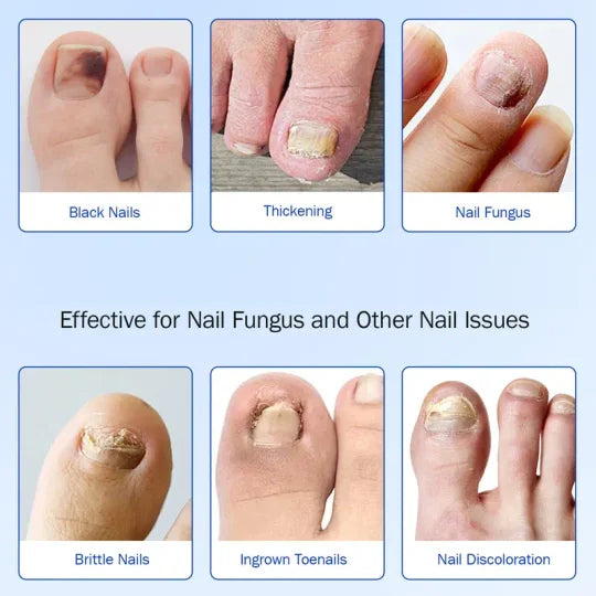 🦶Fungal Nail Care Patches, 21pcs – Treats Nail Fungus & Promotes Healthy Nails✨